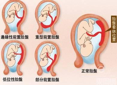 赴美生子风险分析